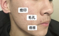 葱白真的能祛痘印吗？