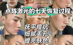 点阵激光祛痘多久能见效？