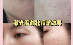 红蓝光祛痘和激光祛痘