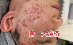 激光祛痘后出血怎么办？