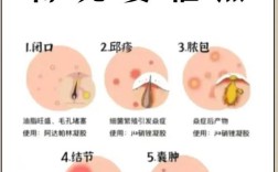 祛痘机构先挤痘有用吗