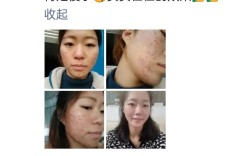 祛痘霜后能马上化妆吗？