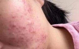 祛痘产品用后皮肤为何会暗沉？