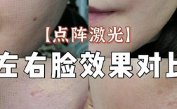 上海点阵激光祛痘印效果如何？
