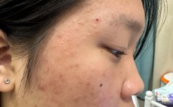 果酸祛痘效果真的好吗？