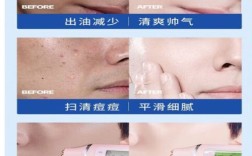 男士祛痘印爽肤水真的有效吗？