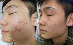 男士祛痘祛痘印，选哪个产品更有效？