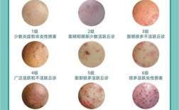 祛痘印费用因人而异吗？