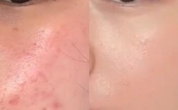 祛痘后能马上化妆吗？