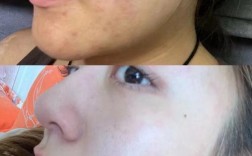 痘痘总是反复 颜值祛痘