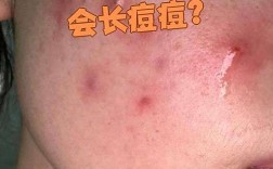 喝酒后爆痘怎么快速消？