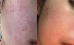 果酸祛痘印真的有效吗？