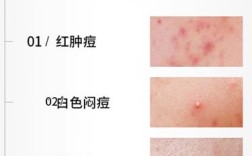 二月祛痘精华液价格多少？