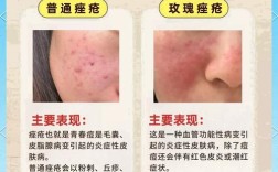 祛痘美容会带来副作用吗？