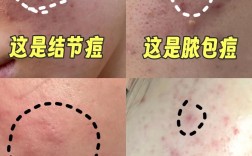 祛痘洁面后反而长痘，是哪里出了问题？