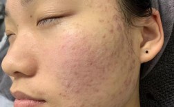 痘印怎么快速消除？