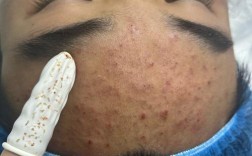 针清祛痘会留痘坑吗？