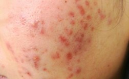 激光祛斑部位总是长痘