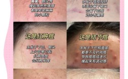 控痘与祛痘有何不同？