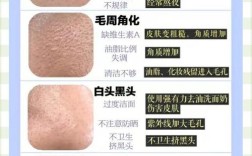 毛孔粗大黑头，该用啥护肤品？