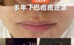 喝祛痘中药后下巴爆痘是为何？