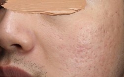 激光祛痘印，到底何时做最好？