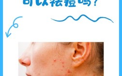 土豆真的能祛痘印吗？日常方法有效吗？