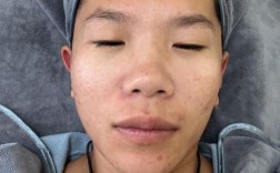 蓝光红光祛痘后真的会结痂吗？