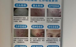 美容院祛痘真的有效吗？