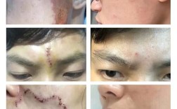 芦荟胶祛痘真的有效吗？