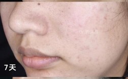 ve祛痘印效果真的好吗？