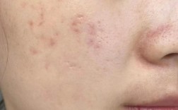 激光祛痘后效果真的好吗？