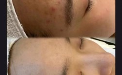 激光祛痘祛痘印有副作用吗？