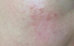 护肤品过敏有哪些症状？