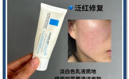 祛痘祛印什么膏效果最好？