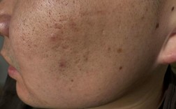 男士痘印痘疤凹洞怎么祛？