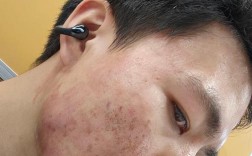 点阵激光祛痘坑效果图