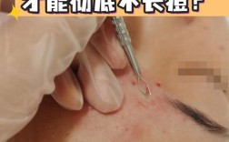 祛痘针一般要多少钱？