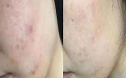 用祛痘产品的时候刺痛