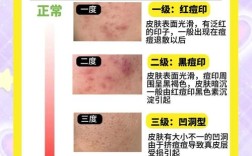 西瓜皮祛痘印几天见效？