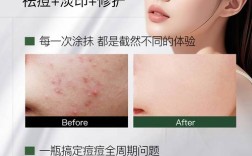 长痘后还能用护肤品吗？