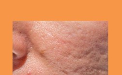 米醋白醋祛痘哪个更有效？