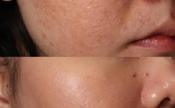 激光祛斑可以去痘印吗