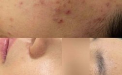 哪款护肤品能闭合性粉刺？