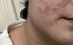 祛痘药膏用后蜕皮正常吗？