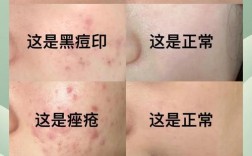 男生祛痘印，哪些方法最有效？