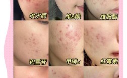 维C涂痘印真能祛痘印吗？