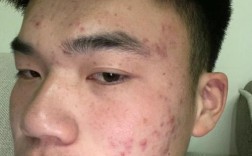 男士祛痘去痘印，什么方法好？