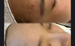 祛痘和美容院，该选哪个学？