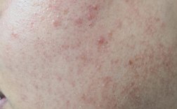 祛痘产品致痒疹怎么办？